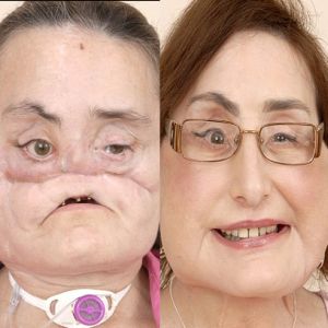 Usa: primo trapianto facciale su una donna. Il calvario di Connie Culp